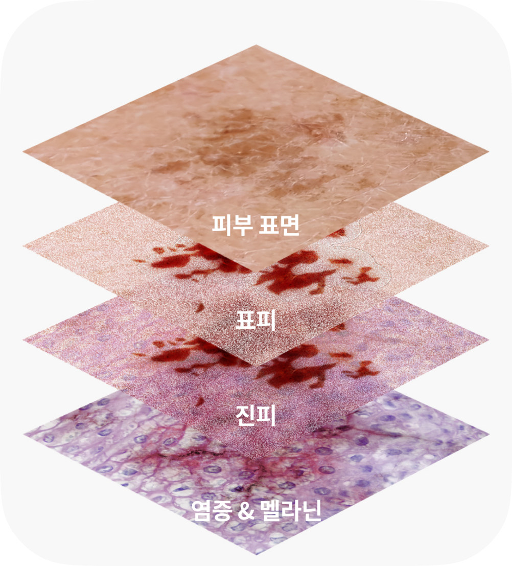 피부 층별 색소 분포