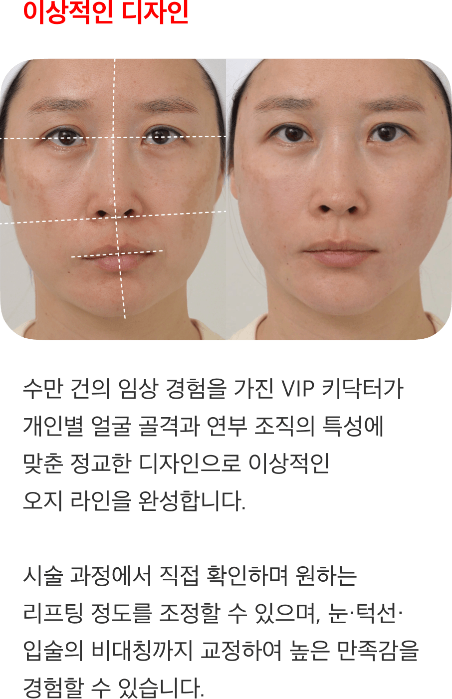 MO 리액터실 시술 부위